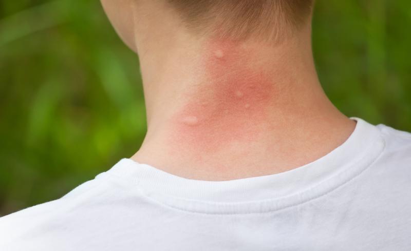 three mosquito bites on neck