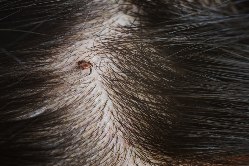 deer tick attached to women's head covered in long dark hair